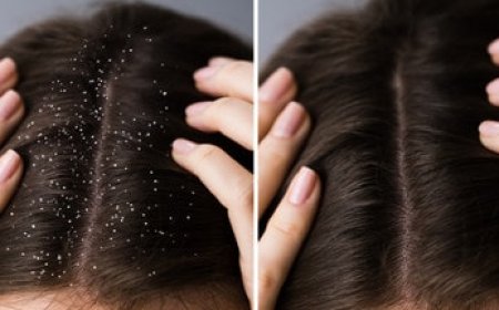 गर्मियों में डैंड्रफ से छुटकारा पाने के लिए अपनाएं ये 5 हेयर ऑयल, बाल रहेंगे स्वस्थ और साफ